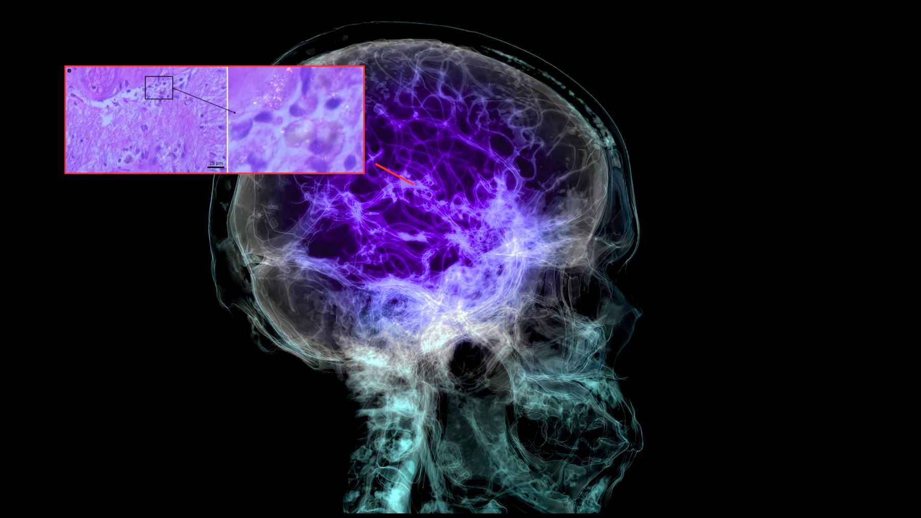Illustration of a human brain with highlighted neural tissue and an inset microscopy image, representing microplastics detected in brain samples.