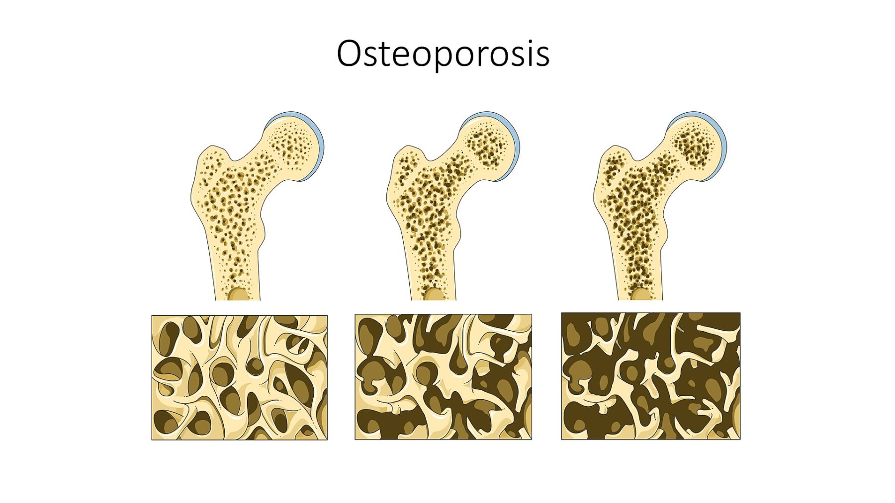 Medical illustration showing progressive bone density loss in osteoporosis with detailed trabecular bone structure