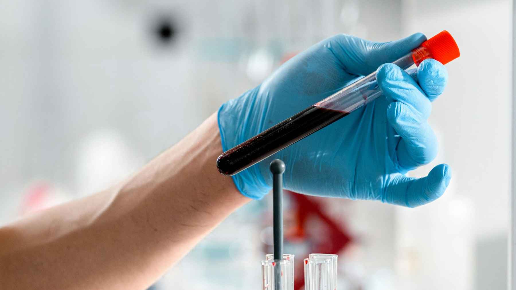 Laboratory analysis of blood samples revealing an ultra rare B(A) genetic mutation