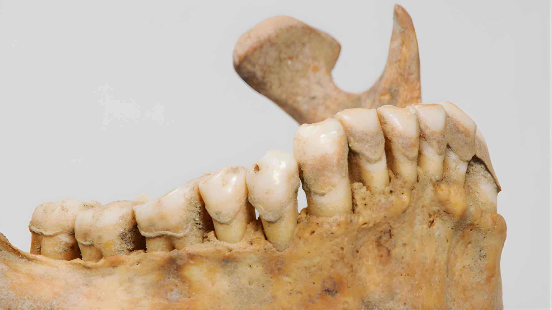 Ancient human jaw with teeth from Thailand, linked to evidence of betel consumption found in 4,000-year-old dental plaque