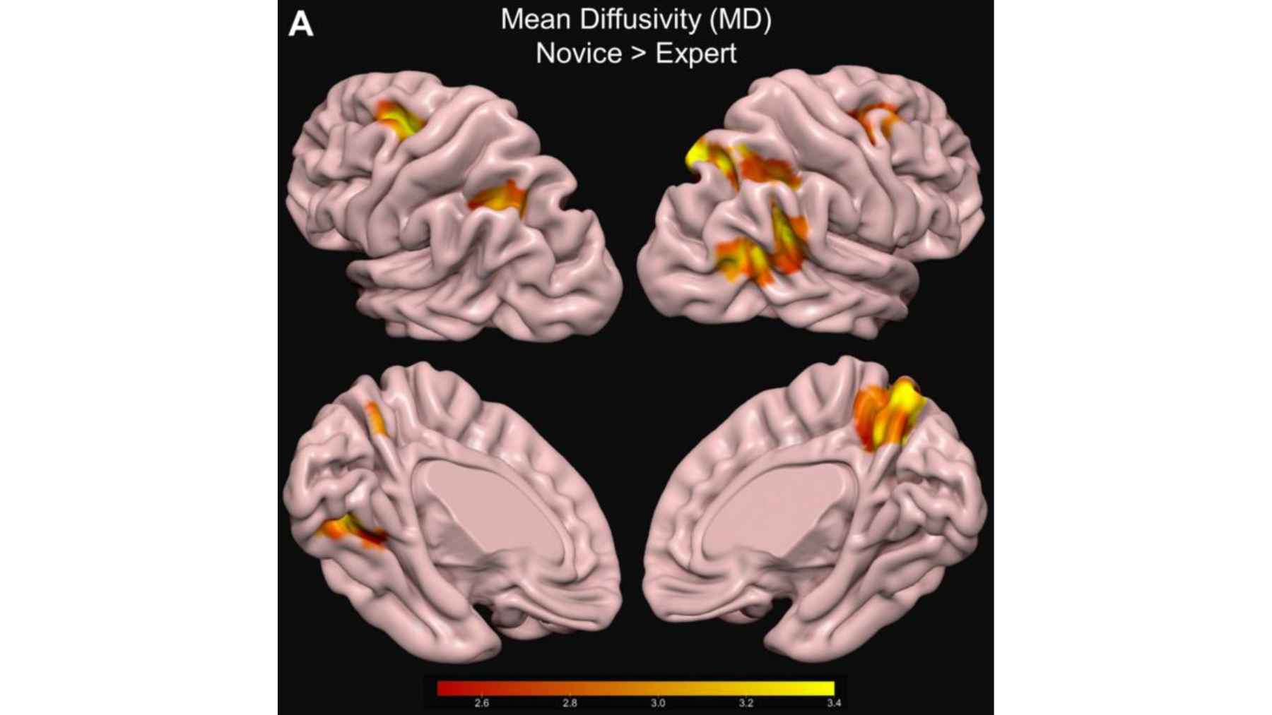 Brain scan comparison showing mean diffusivity differences between expert birdwatchers and novices in attention-related regions