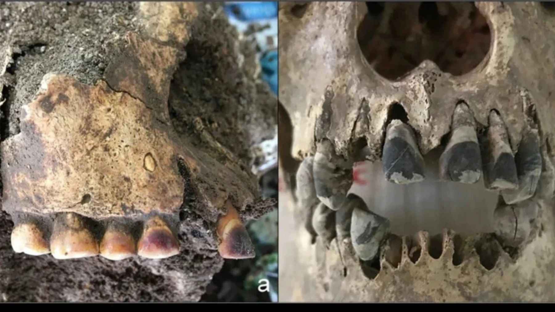Ancient skulls from Vietnam showing blackened teeth from Iron Age cultural practices