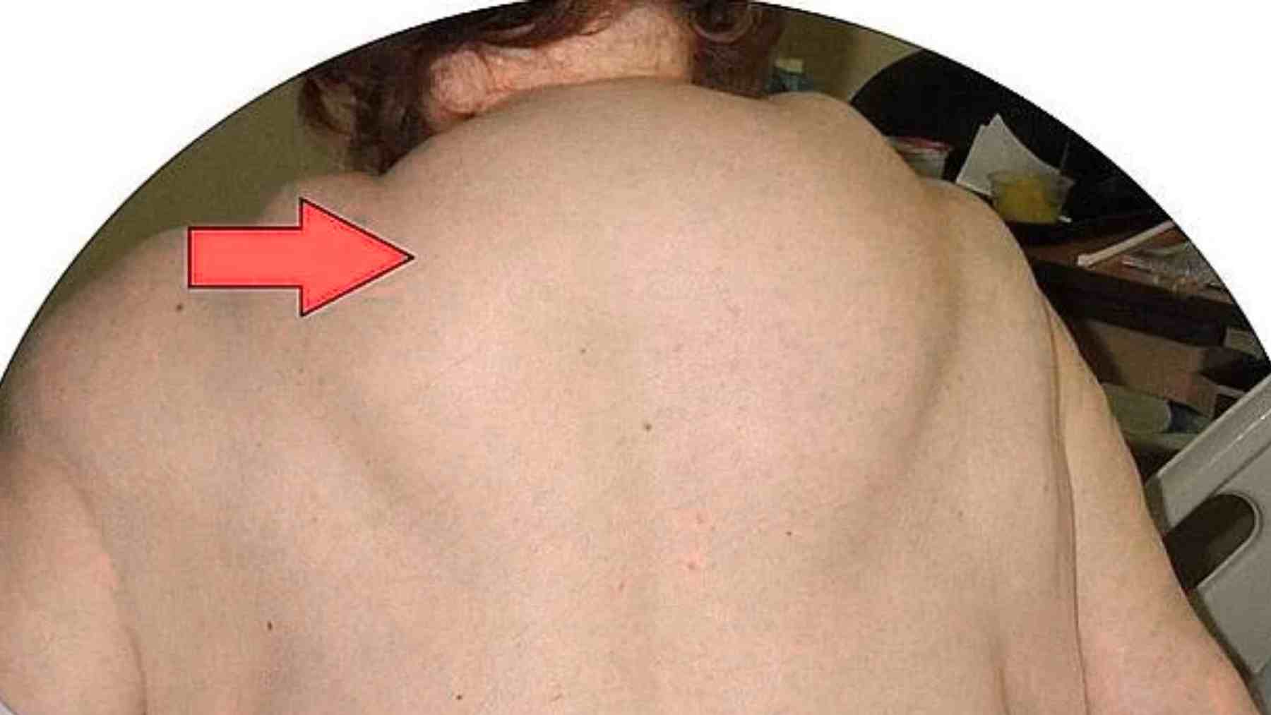 That lump on your back is NOT normal: a “buffalo hump” could be an early sign of diabetes, high cholesterol, or liver damage… and almost no one knows how to spot it in time