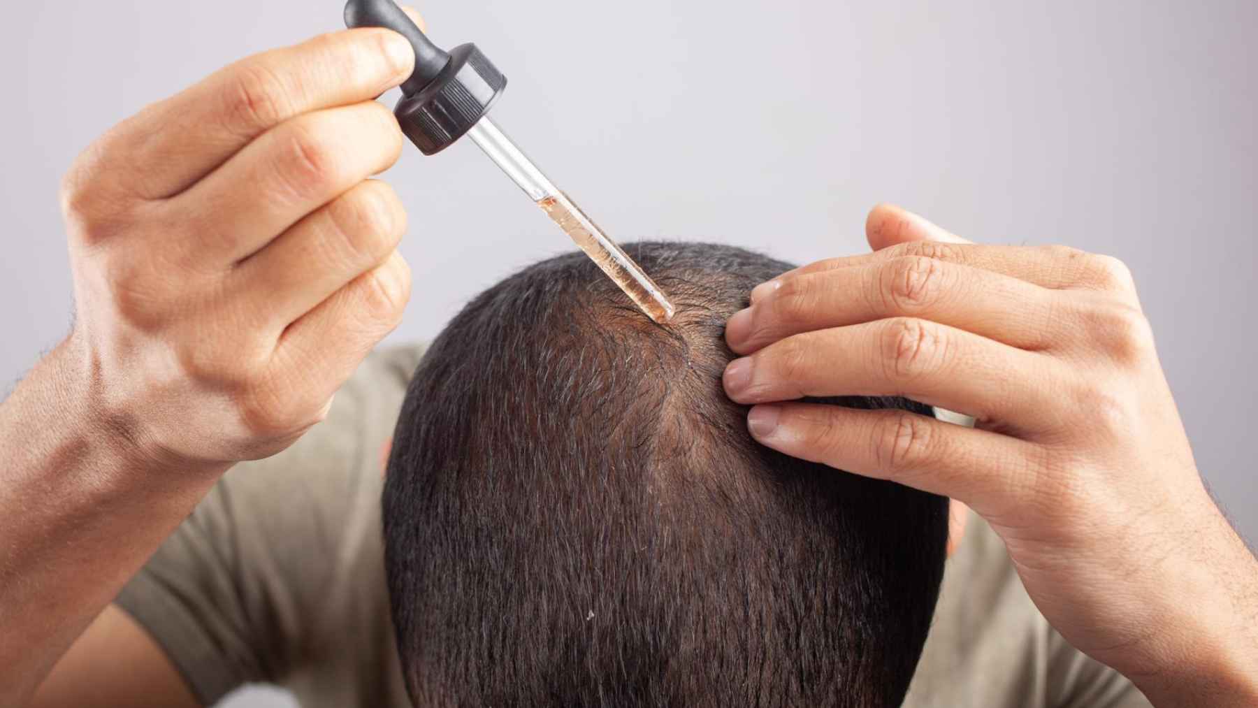 Applying a hair growth serum with a dropper to thinning areas on the scalp.