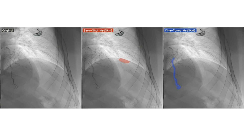 AI comparison showing improved coronary artery segmentation in X-ray angiogram after fine-tuning