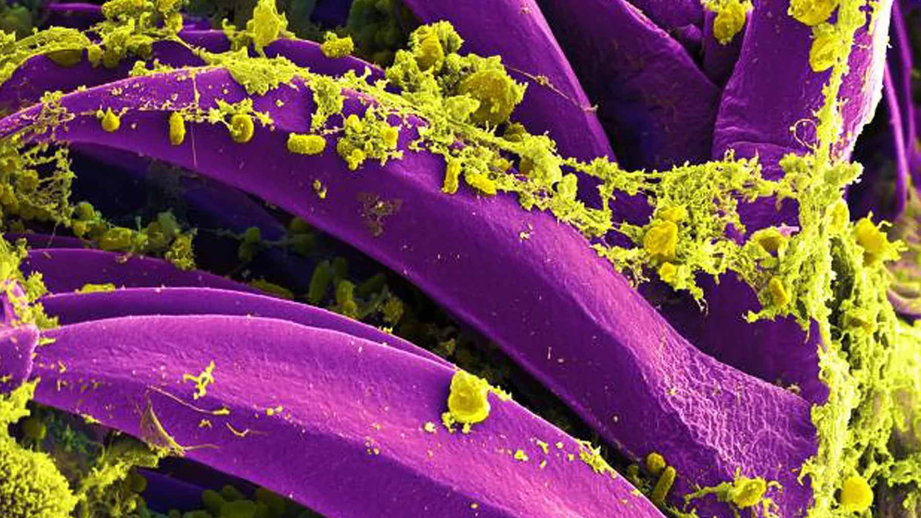 The plague may have claimed the lives of children in hunter-gatherer communities in Siberia 5,500 years ago, long before medieval cities, flea-infested rats, and the dreaded Black Death existed 1 Ancient dental remains from a Siberian excavation site used by researchers to identify prehistoric traces of the Yersinia pestis bacterium.