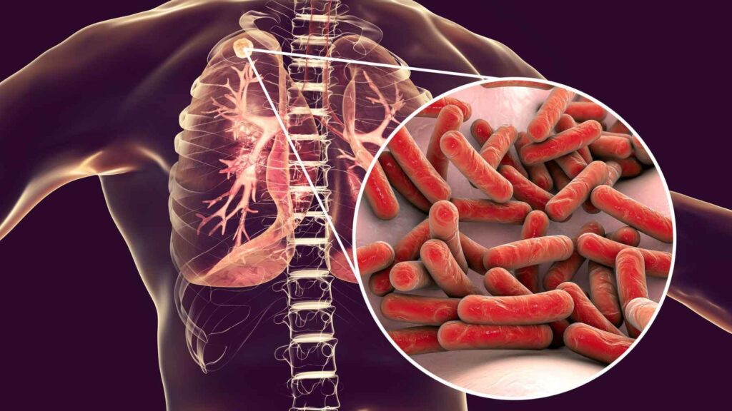 Illustration of tuberculosis infection in human lungs with Mycobacterium tuberculosis bacteria close-up