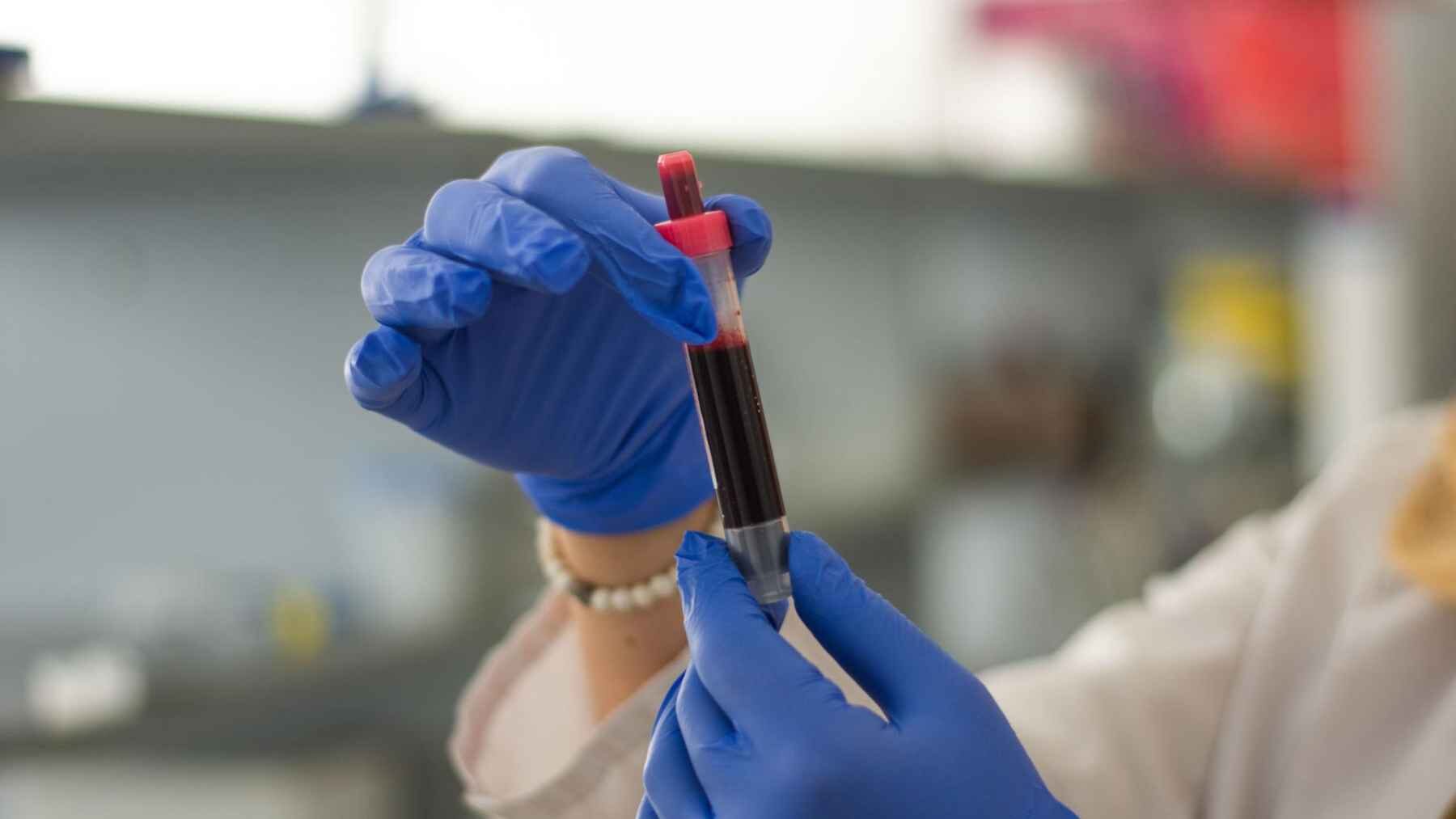 A laboratory technician examines a blood sample collected for microplastic analysis in cardiovascular research.
