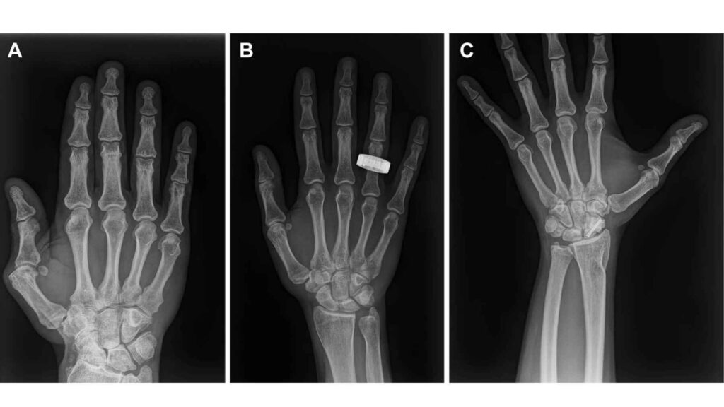 Hand X-rays captured during the first successful human radiography experiment performed aboard the Fram2 orbital mission.