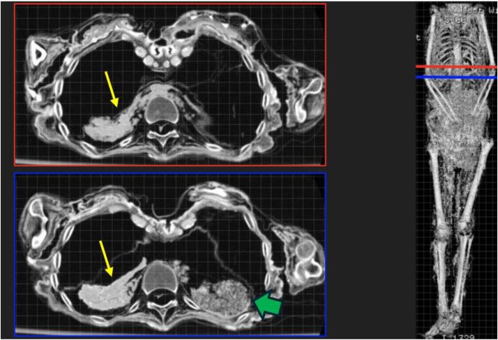 CT cross sections of the Braided Lady mummy showing dried liver remnants and other abdominal organs still in place