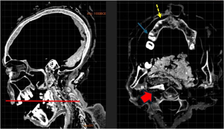 CT scan of the Braided Lady's skull and jaw showing gum disease, a fractured molar and an incisor displaced toward the throat
