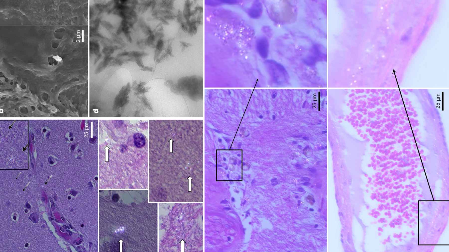 Micrografías de tejido cerebral con partículas de micro y nanoplásticos señaladas por flechas y recuadros