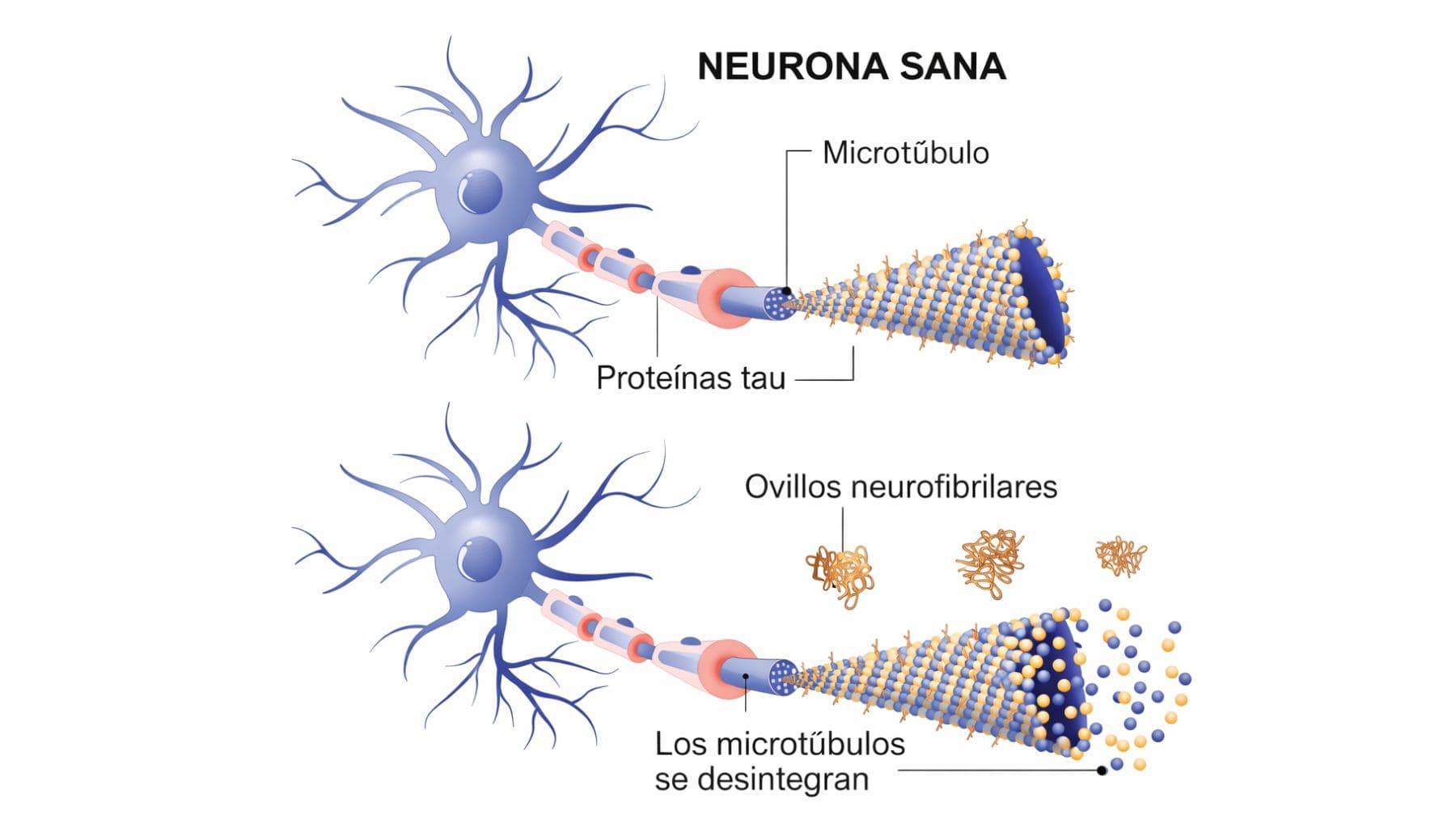 Ilustración del papel de la proteína tau en neuronas sanas y en el Alzheimer.
