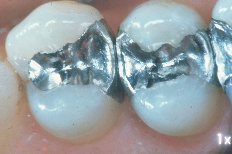 Europa prohíbe el mercurio dental en niños y mujeres embarazadas