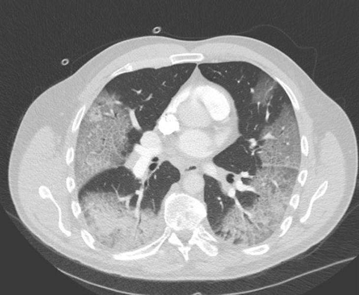 La edad de inicio de TAC es cada vez más temprana