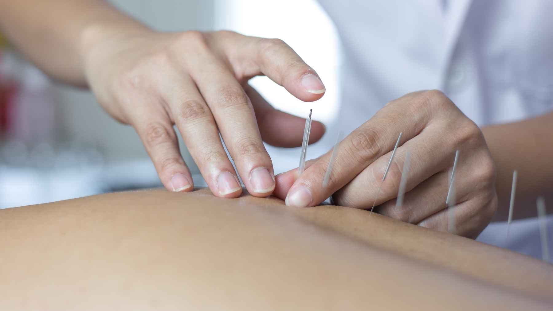 Profesional sanitario aplica acupuntura como ejemplo de medicina tradicional integrada en la atención médica