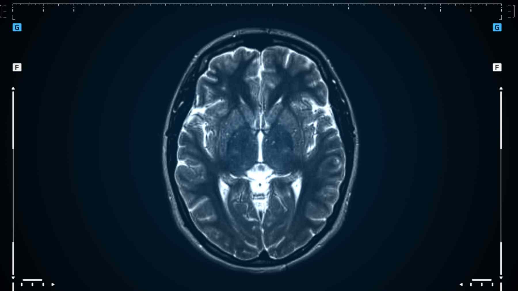 Escáner cerebral que muestra posibles efectos de la contaminación del aire en el cerebro infantil