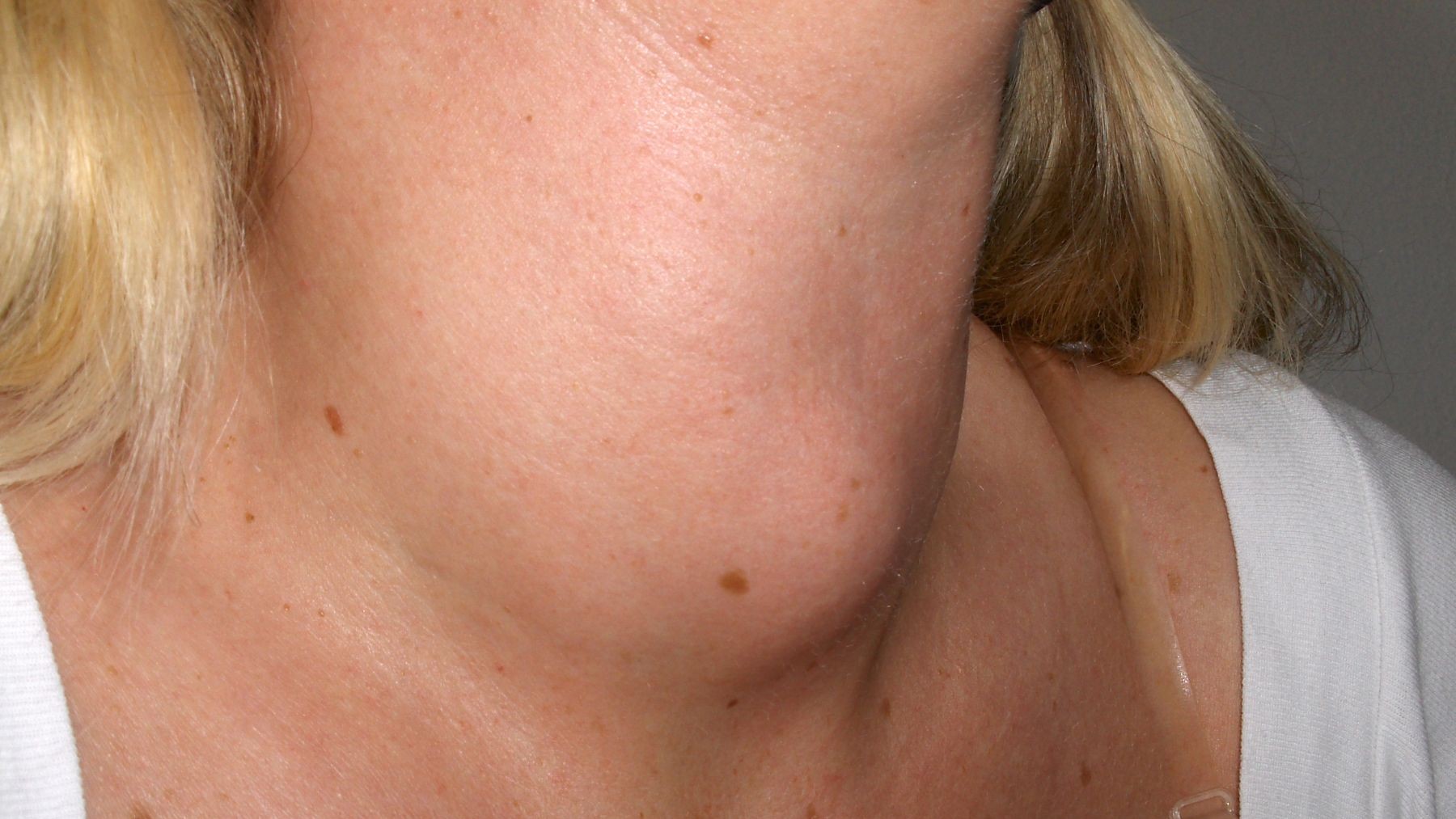 trastornos de la tiroides