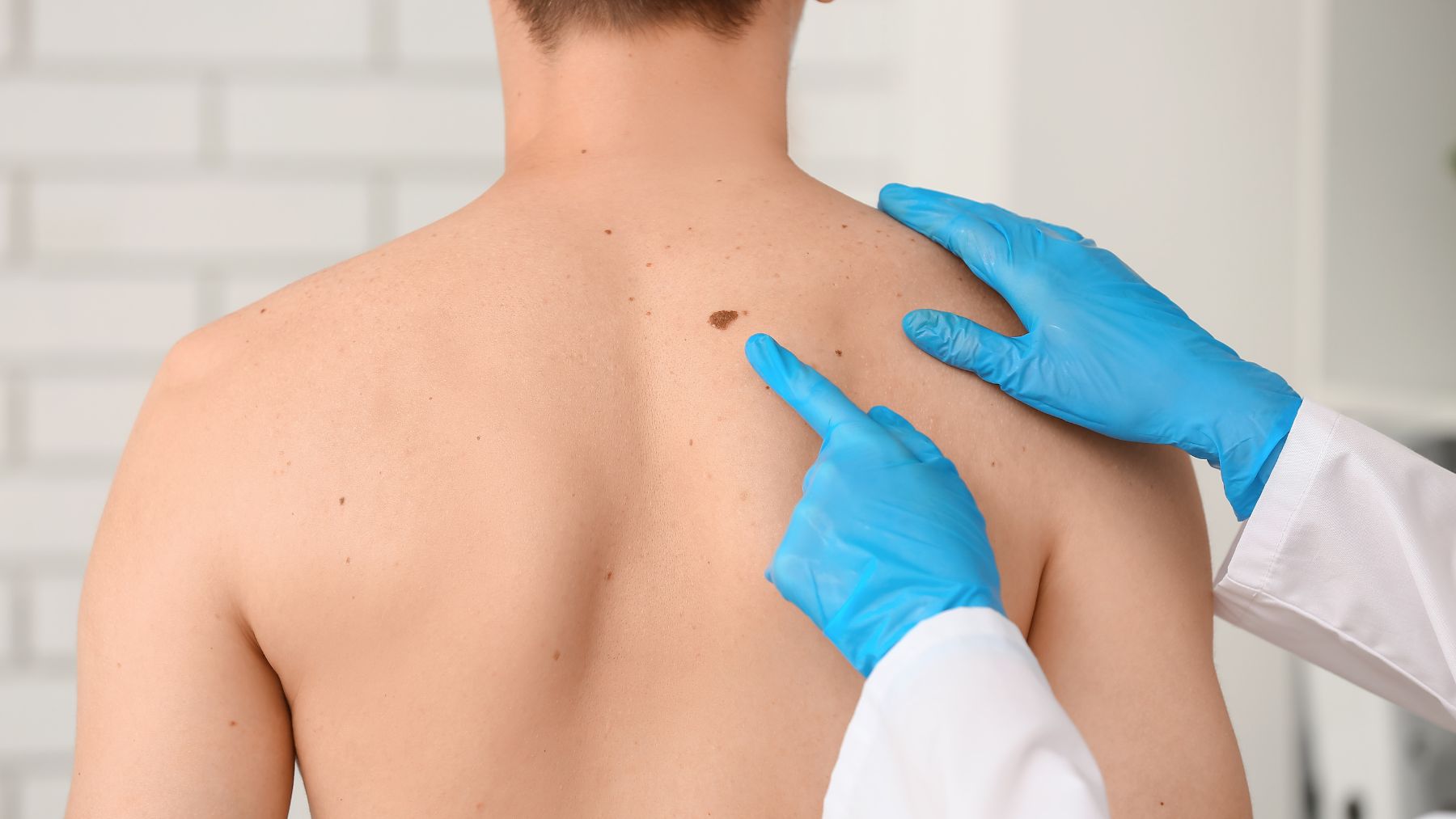 Dermatólogo examina lunar sospechoso en la espalda relacionado con riesgo de melanoma por cabinas de bronceado.